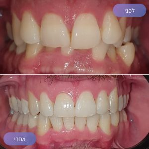 יישור שיניים אינויזליין (Invisalign): המדריך המעודכן לשנת 2024 1