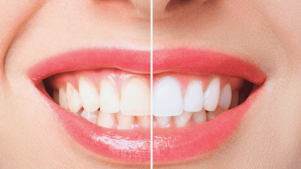 הלבנת שיניים: כל מה שצריך לדעת 1