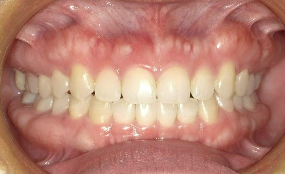 רווחים בשיניים תמונת אחרי לסת תקינה וחיוך מדהים