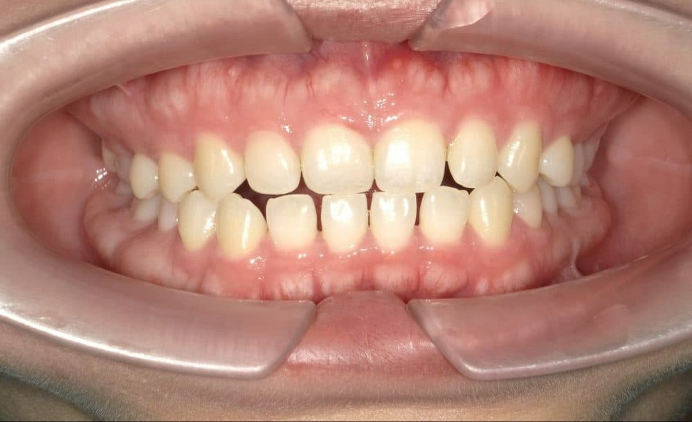 רווחים בשיניים לפני טיפול יישור שיניים