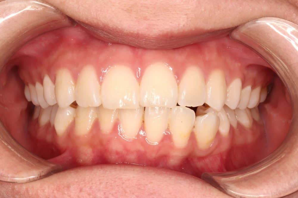 מנשך מוצלב לפני טיפול ביישור שיניים שקוף של אינויזיליין