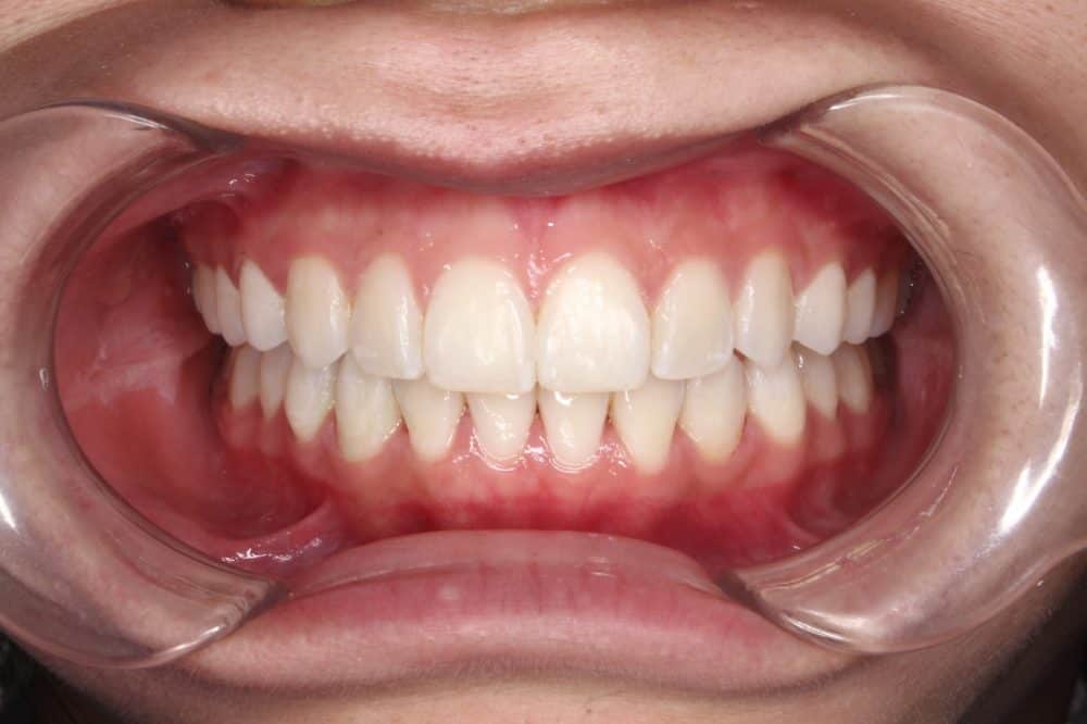מנשך מוצלב אחרי טיפול ביישור שיניים שקוף של אינויזיליין
