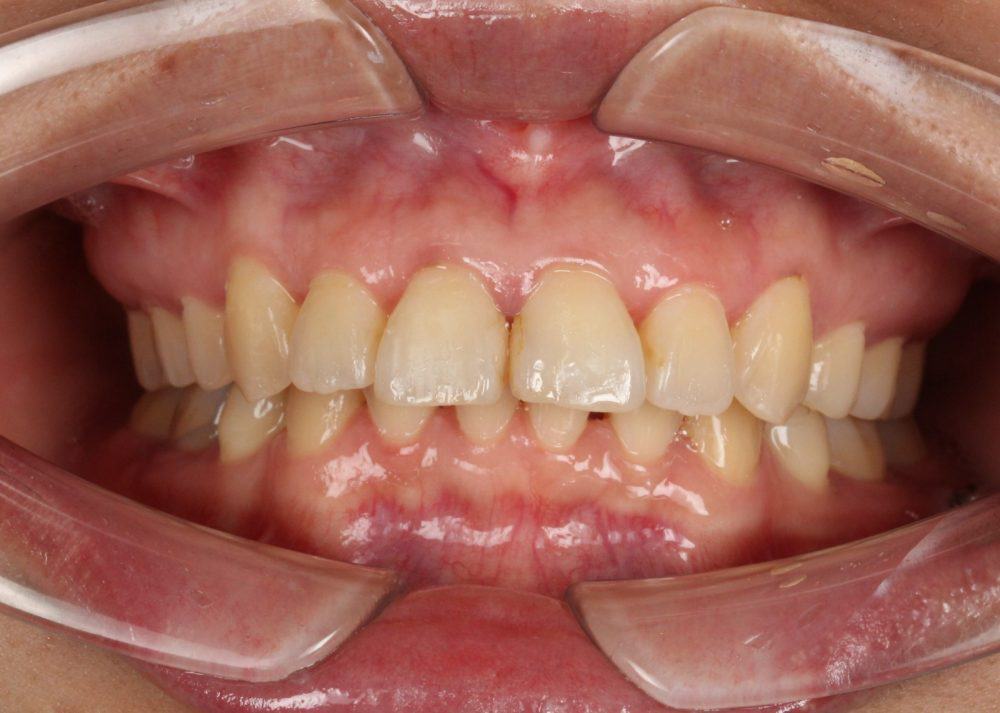 מנשך עמוק לפני טיפול ביישור שיניים שקוף של אינויזיליין