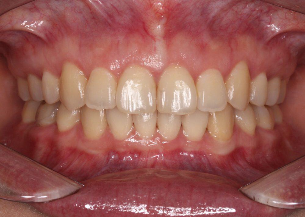 מנשך עמוק אחרי טיפול ביישור שיניים שקוף של אינויזיליין