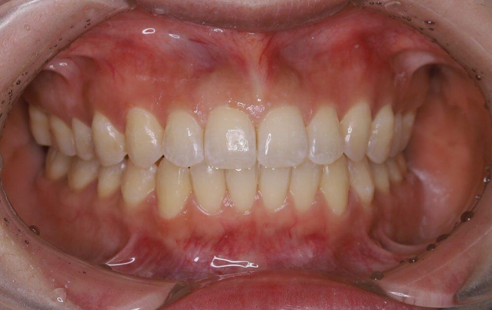 מנשך פתוח אחרי יישור שיניים בקשתיות שקופות