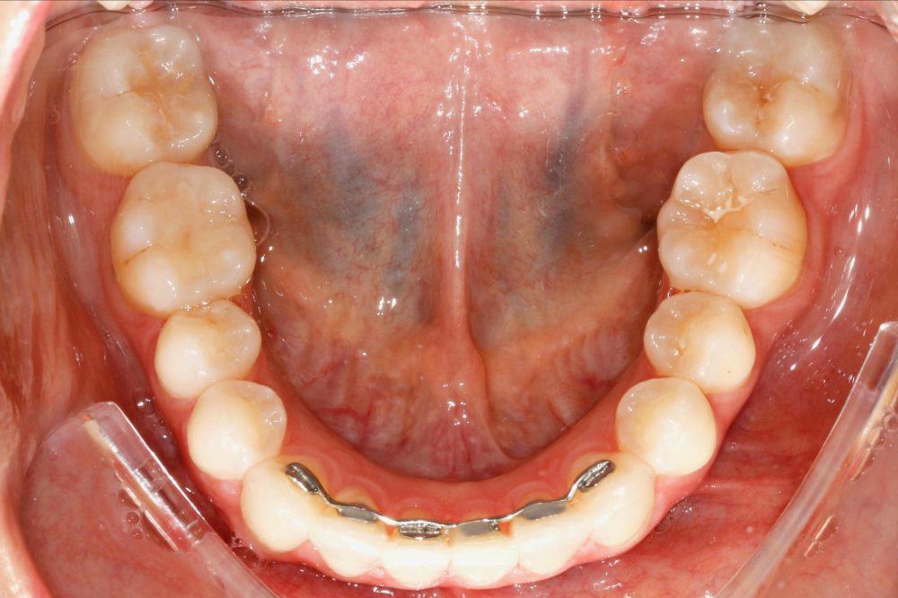 צפיפות בשיניים תמונת אחרי יישור שיניים שקוף לסת תחתונה