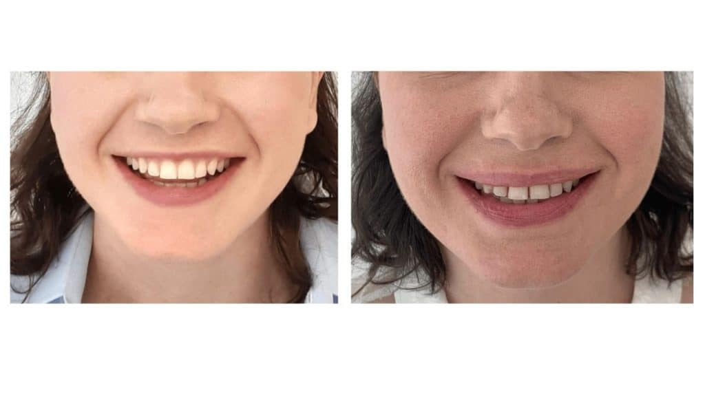 רווח בשיניים - לפני ואחרי יישור
